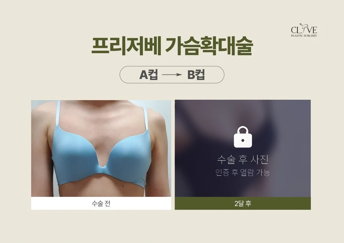 Breast Augmentation Preserve Breast Augmentation Before & After
