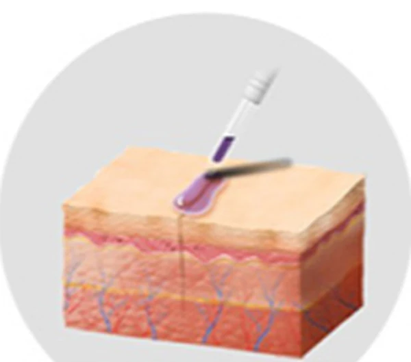 Sutureless Medical Adhesive Closure