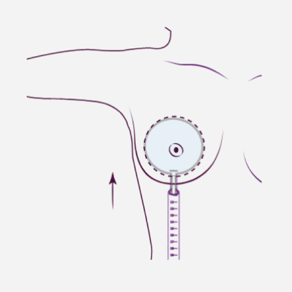 Tissue Expander Balloon Diagram