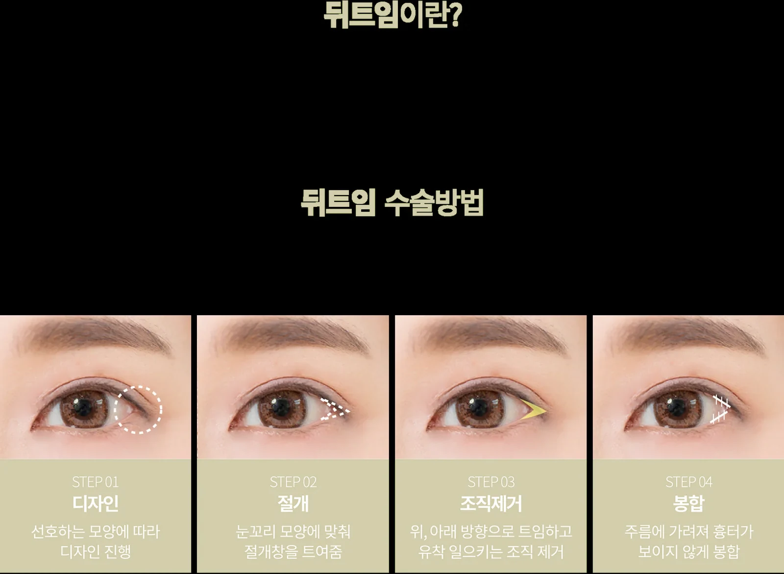 Canthoplasty