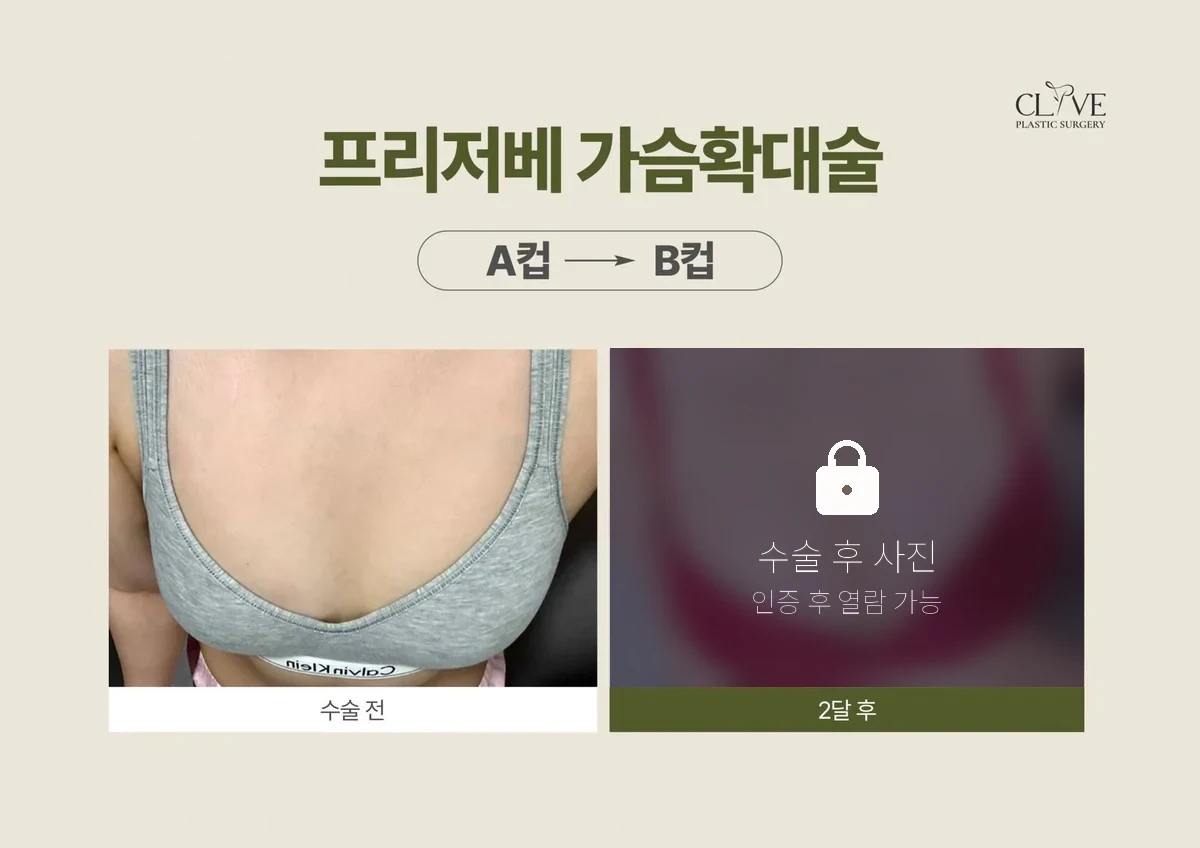 가슴성형 프리저베 가슴성형 전후