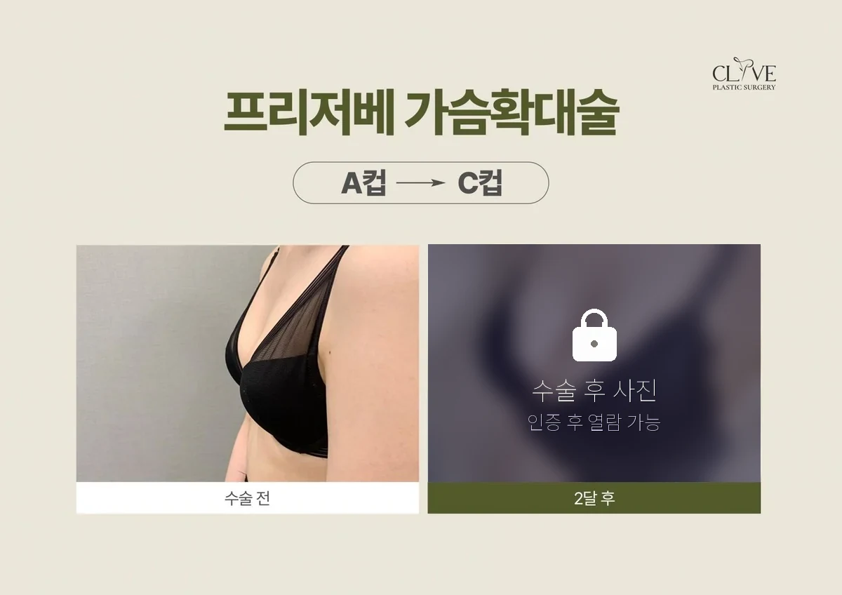 가슴성형 프리저베 가슴성형 전후