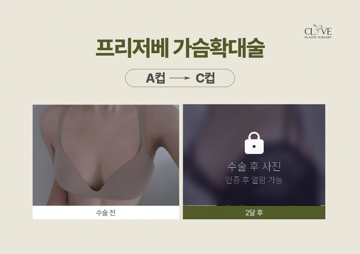 가슴성형 프리저베 가슴성형 전후