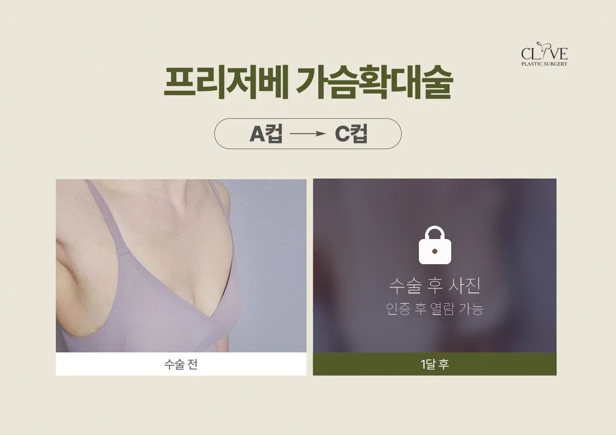 가슴성형 프리저베 가슴성형 전후