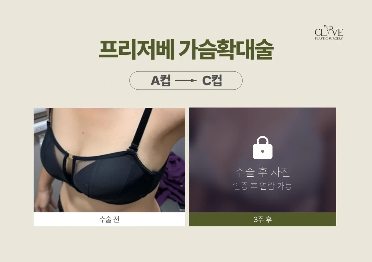 가슴성형 프리저베 가슴성형 전후