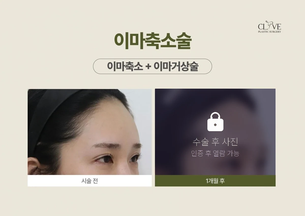 리프팅 이마축소 + 이마거상 전후
