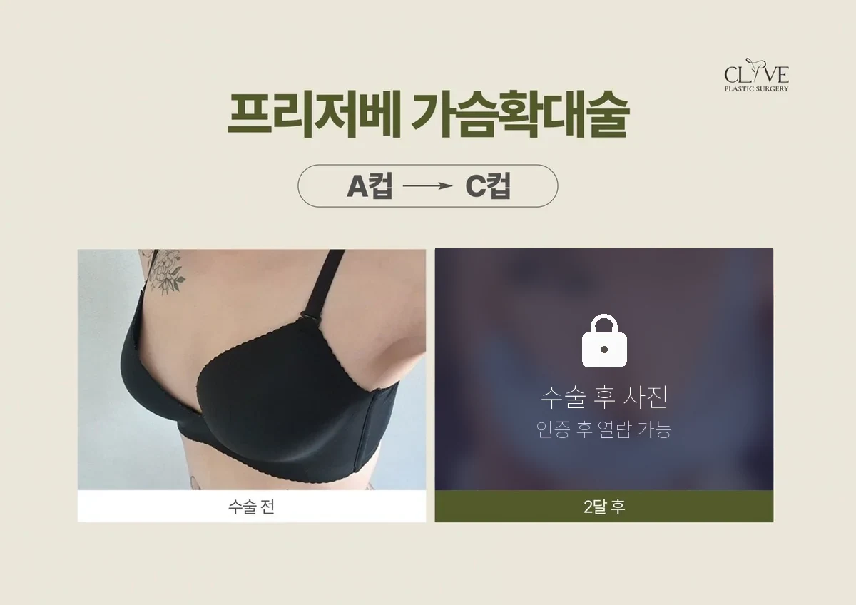 가슴성형 프리저베 가슴성형 전후