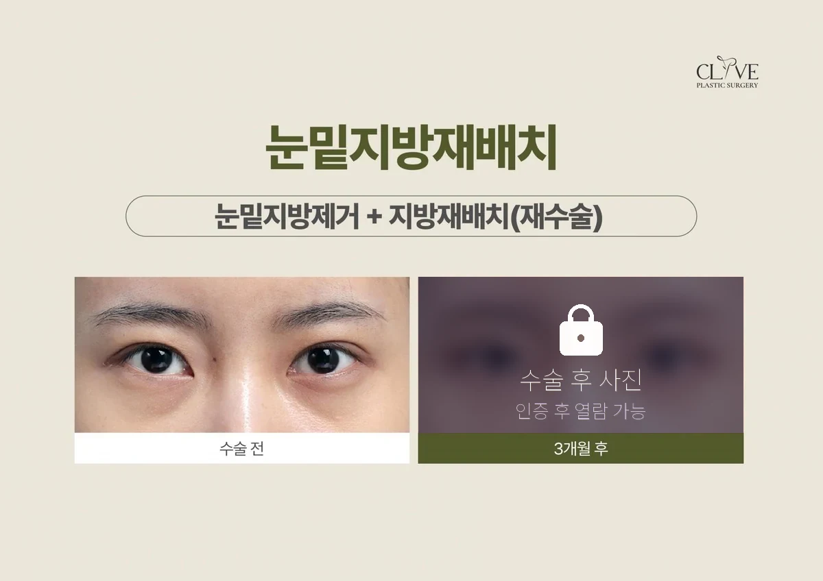 눈성형 눈밑지방제거 + 재배치 재수술 전후
