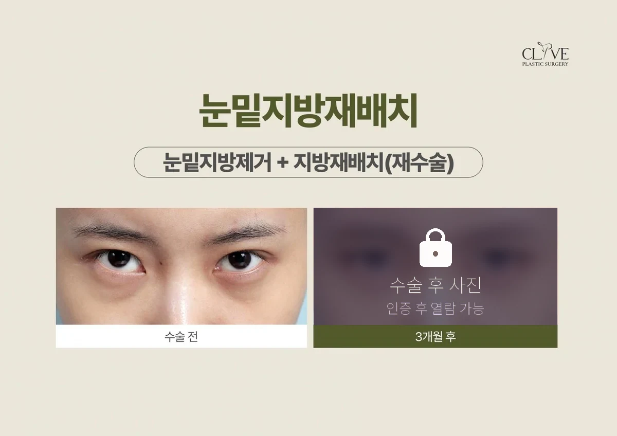눈성형 눈밑지방제거 + 재배치 재수술 전후