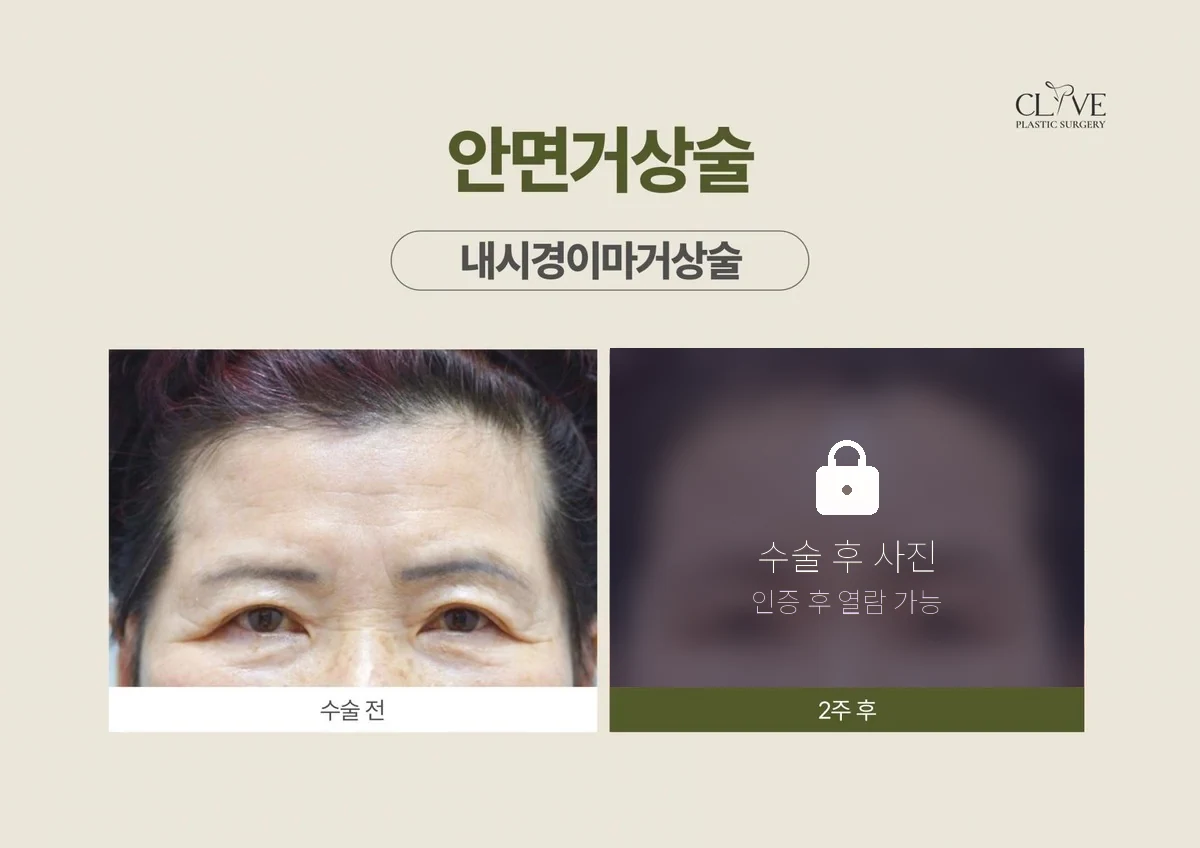 리프팅 내시경이마거상 전후