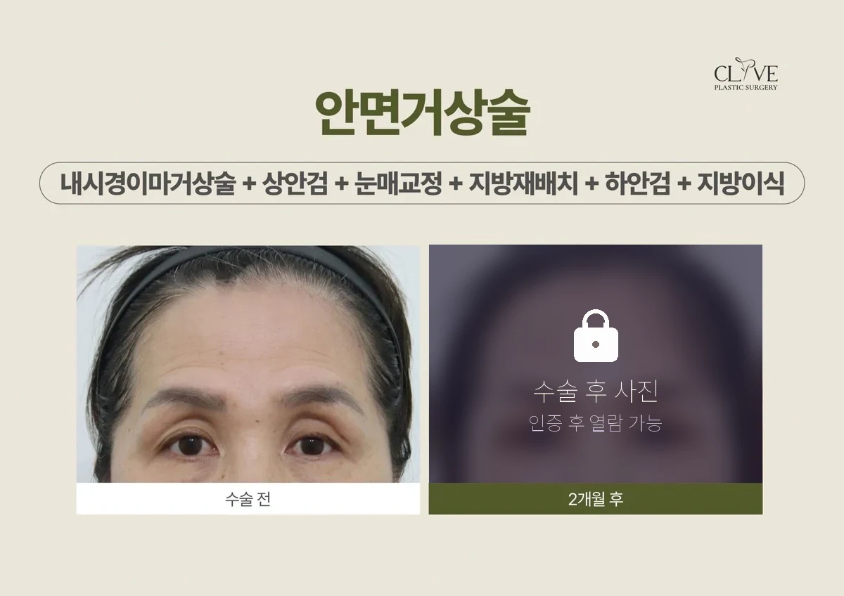 리프팅 내시경이마거상 + 상안검 + 눈매교정 + 하안검 전후