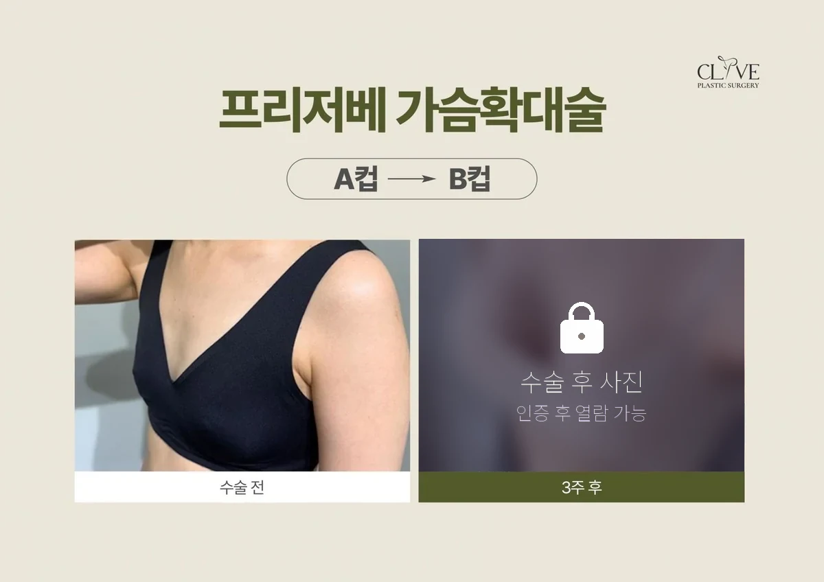 가슴성형 프리저베 가슴성형 전후