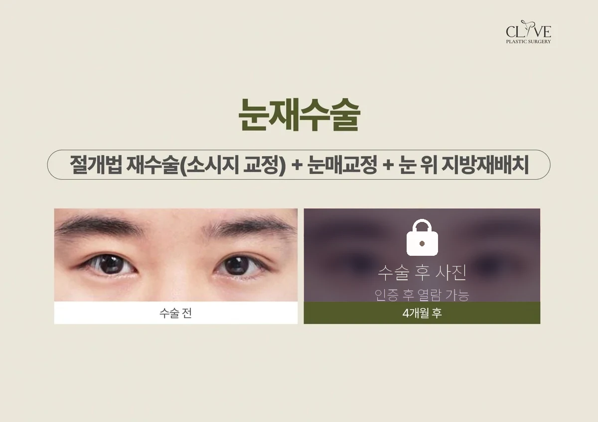 눈성형 절개 재수술 + 눈매교정 + 눈 위 지방재배치 전후