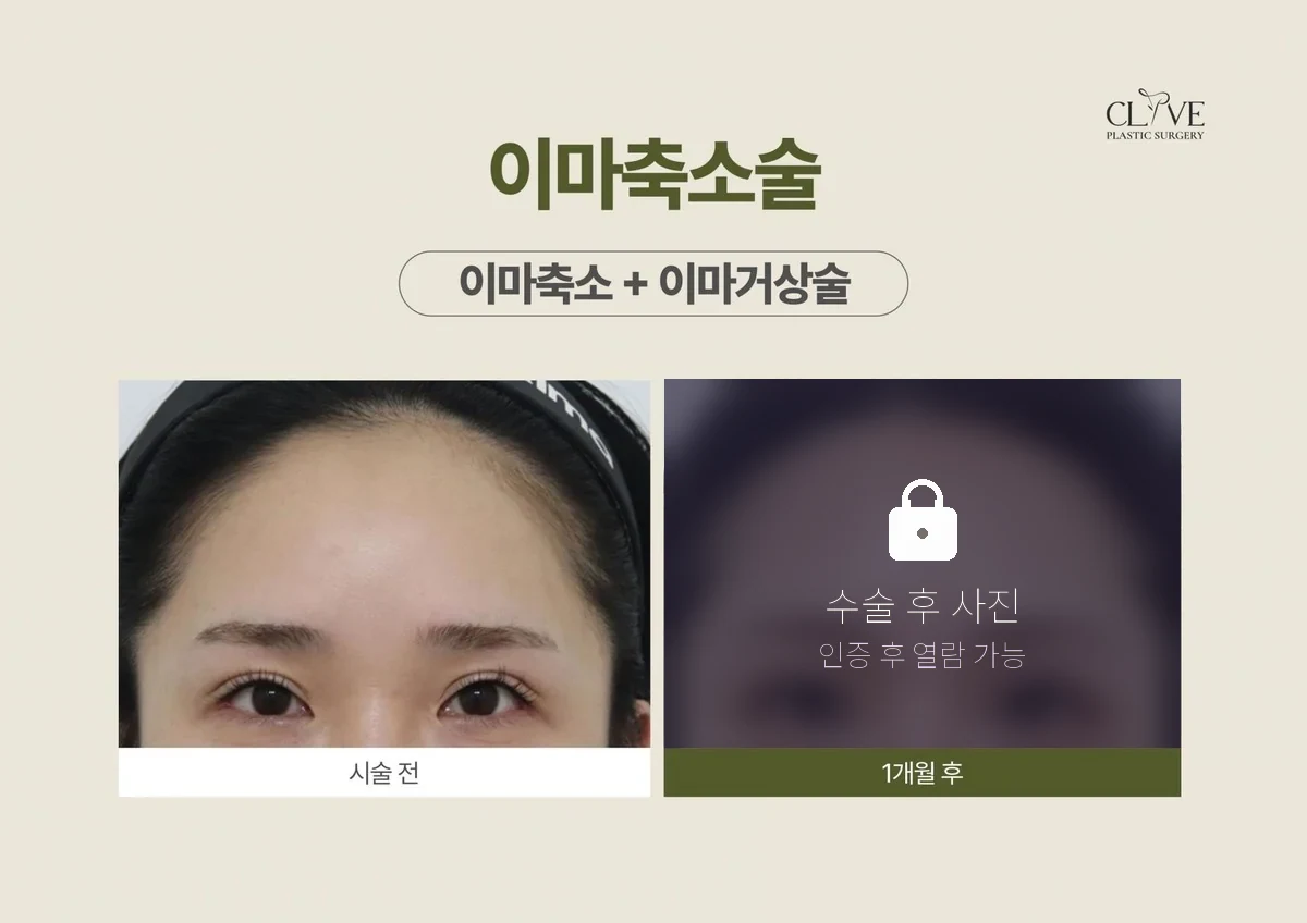 리프팅 이마축소 + 이마거상 전후