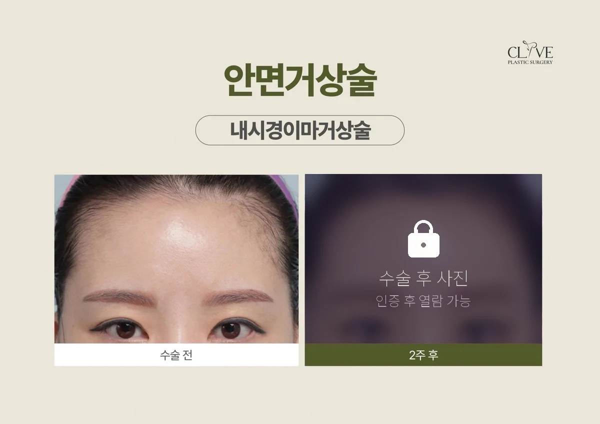 리프팅 내시경이마거상 전후