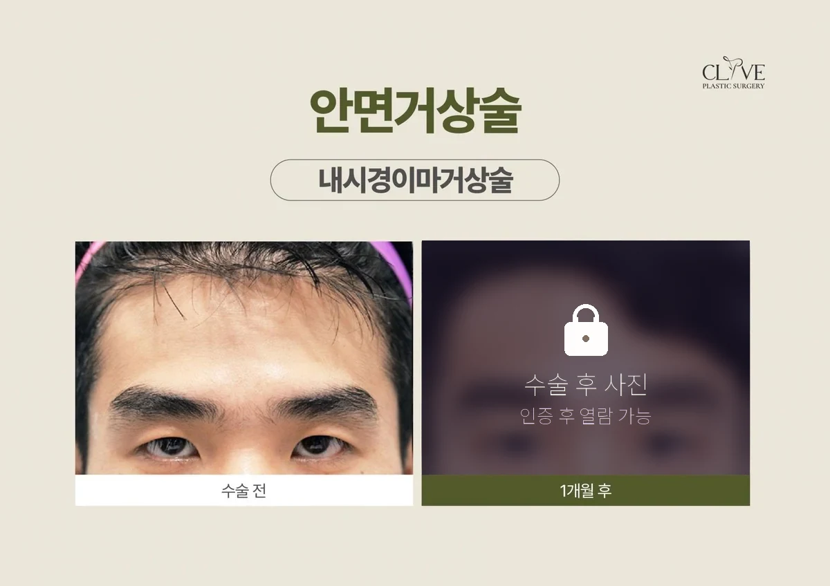 리프팅 내시경이마거상 전후