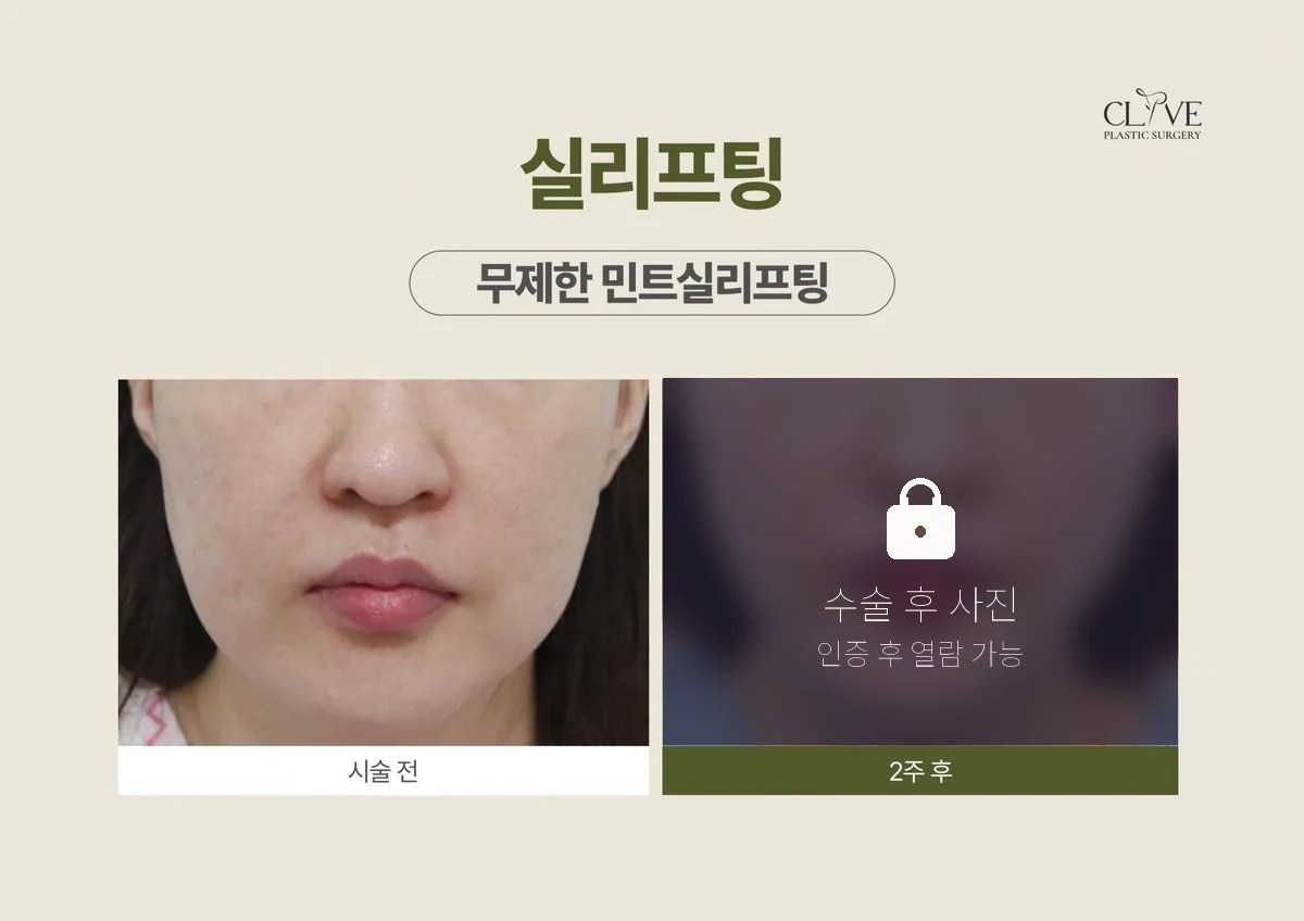 리프팅 실리프팅 전후