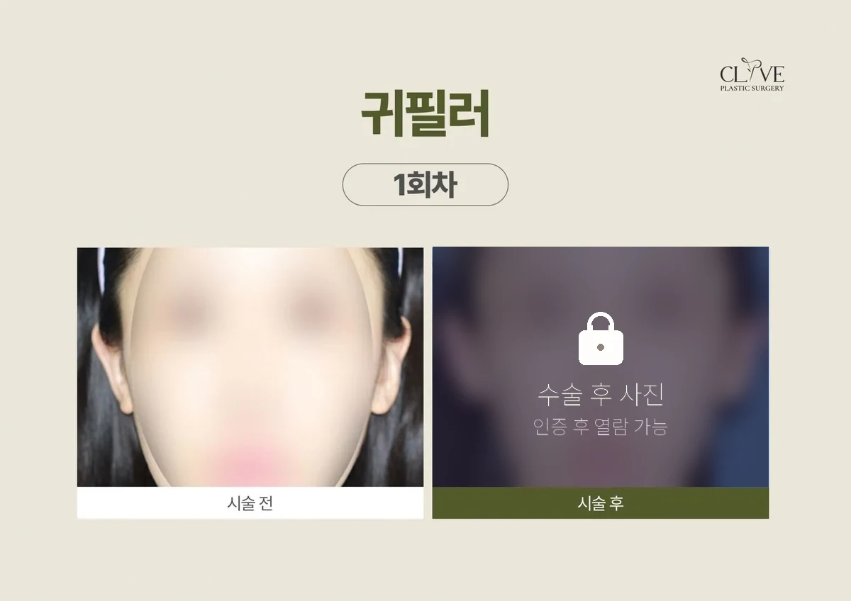 쁘띠시술 귀필러 전후
