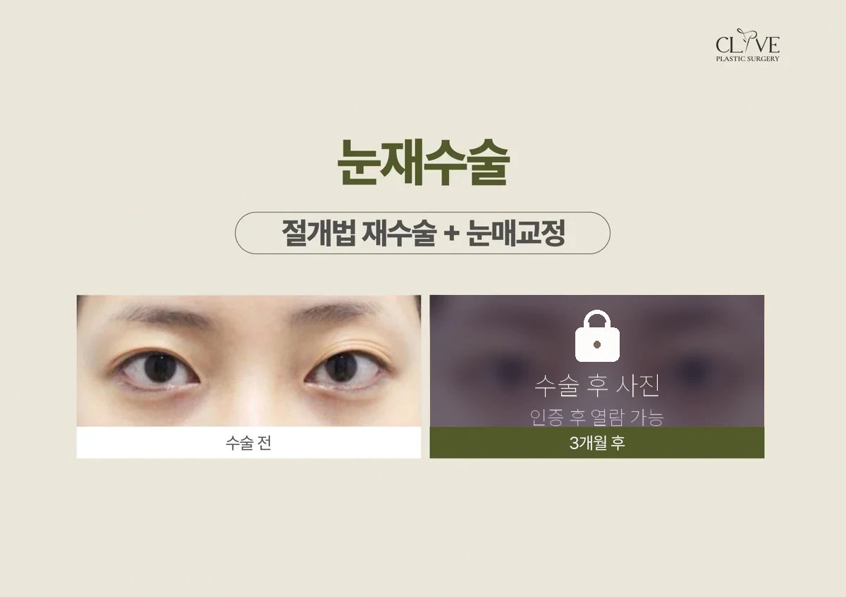 눈성형 절개 재수술 + 눈매교정 전후