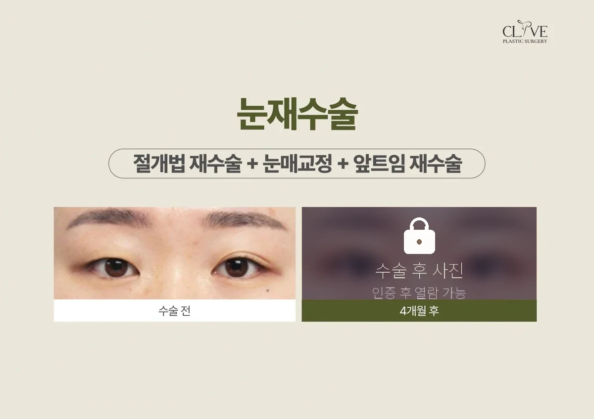 눈성형 절개 재수술 + 눈매교정 + 앞트임 재수술 전후