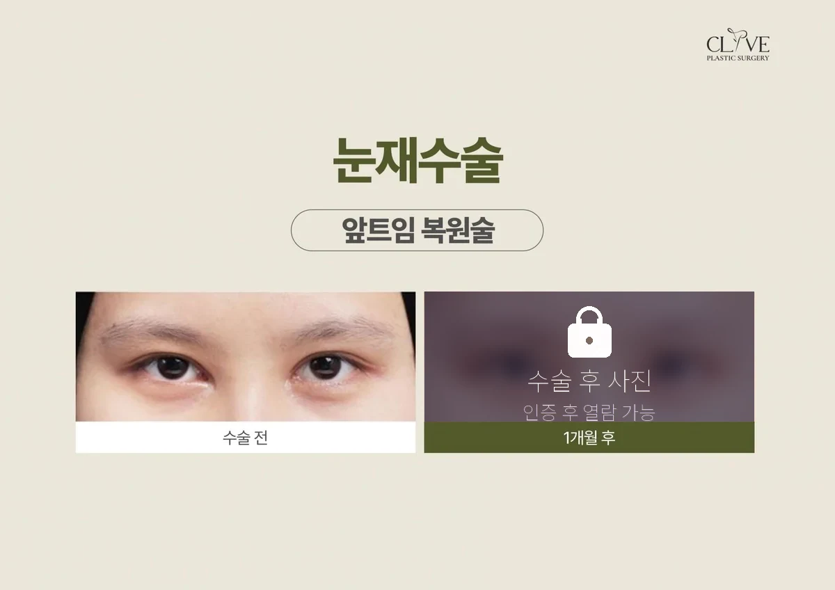 눈성형 앞트임 복원 전후