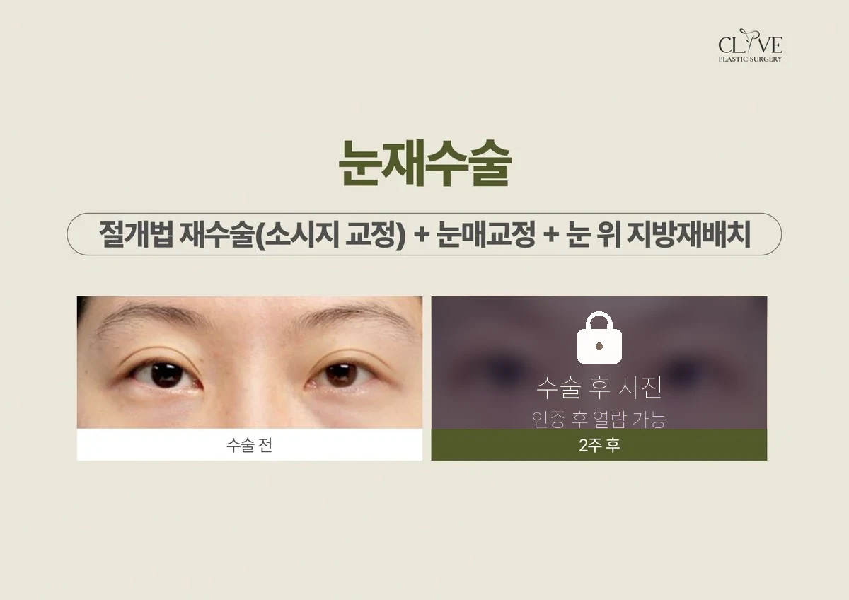 눈성형 절개 소시지 교정 + 눈매교정 + 눈 위 지방재배치 전후