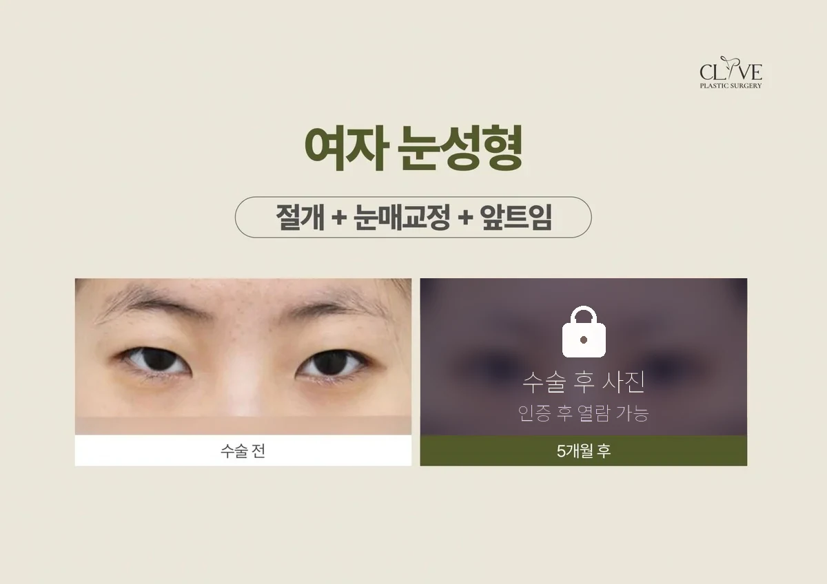 눈성형 절개 + 눈매교정 + 앞트임 전후