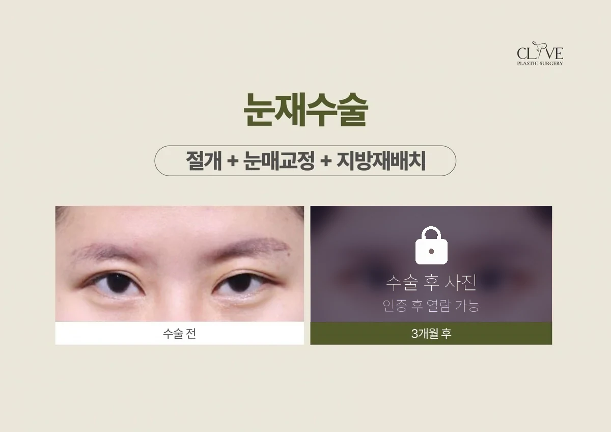 눈성형 절개+눈매교정+지방재배치 (재수술) 전후