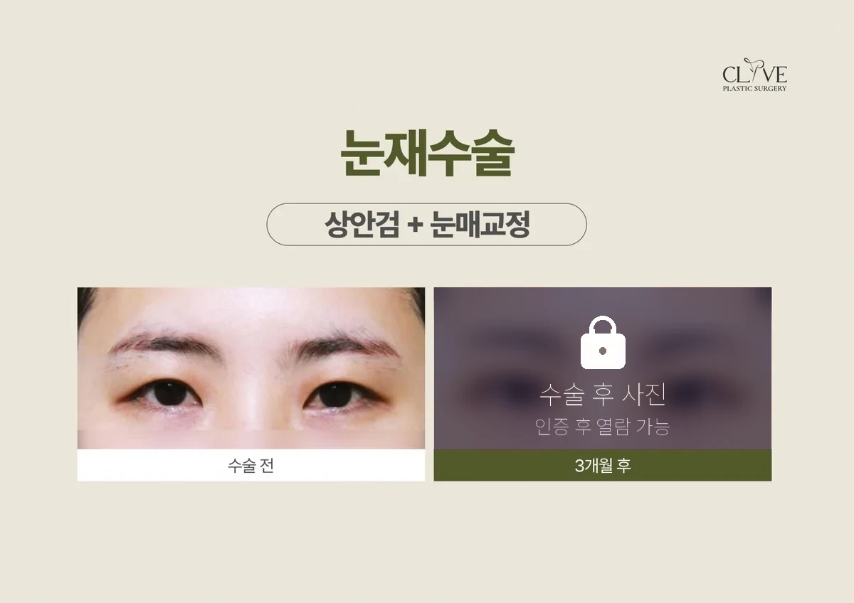 눈성형 상안검+눈매교정(재수술) 전후