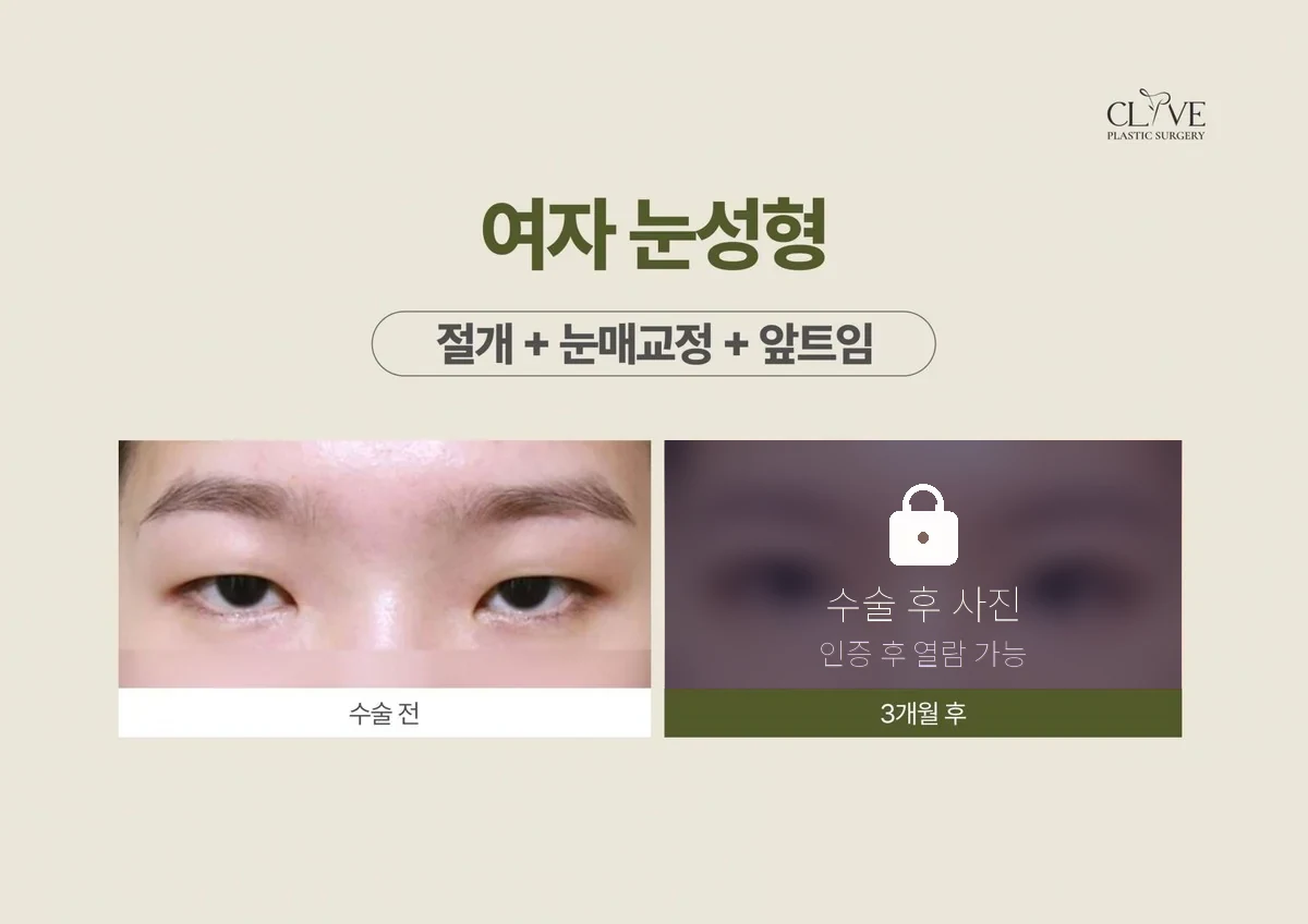 눈성형 절개+눈매교정+앞트임 전후