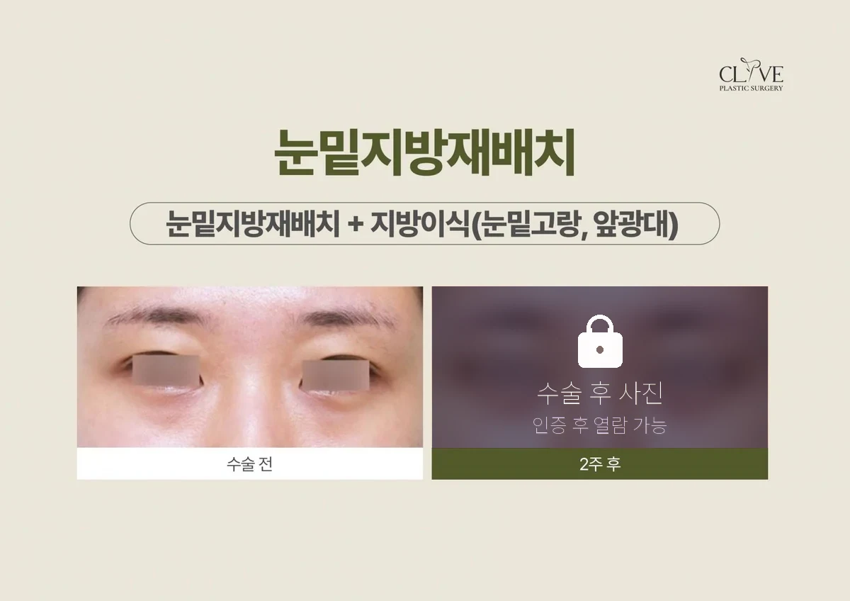 눈성형 눈밑지방재배치+지방이식(눈밑고랑+앞광대) 전후