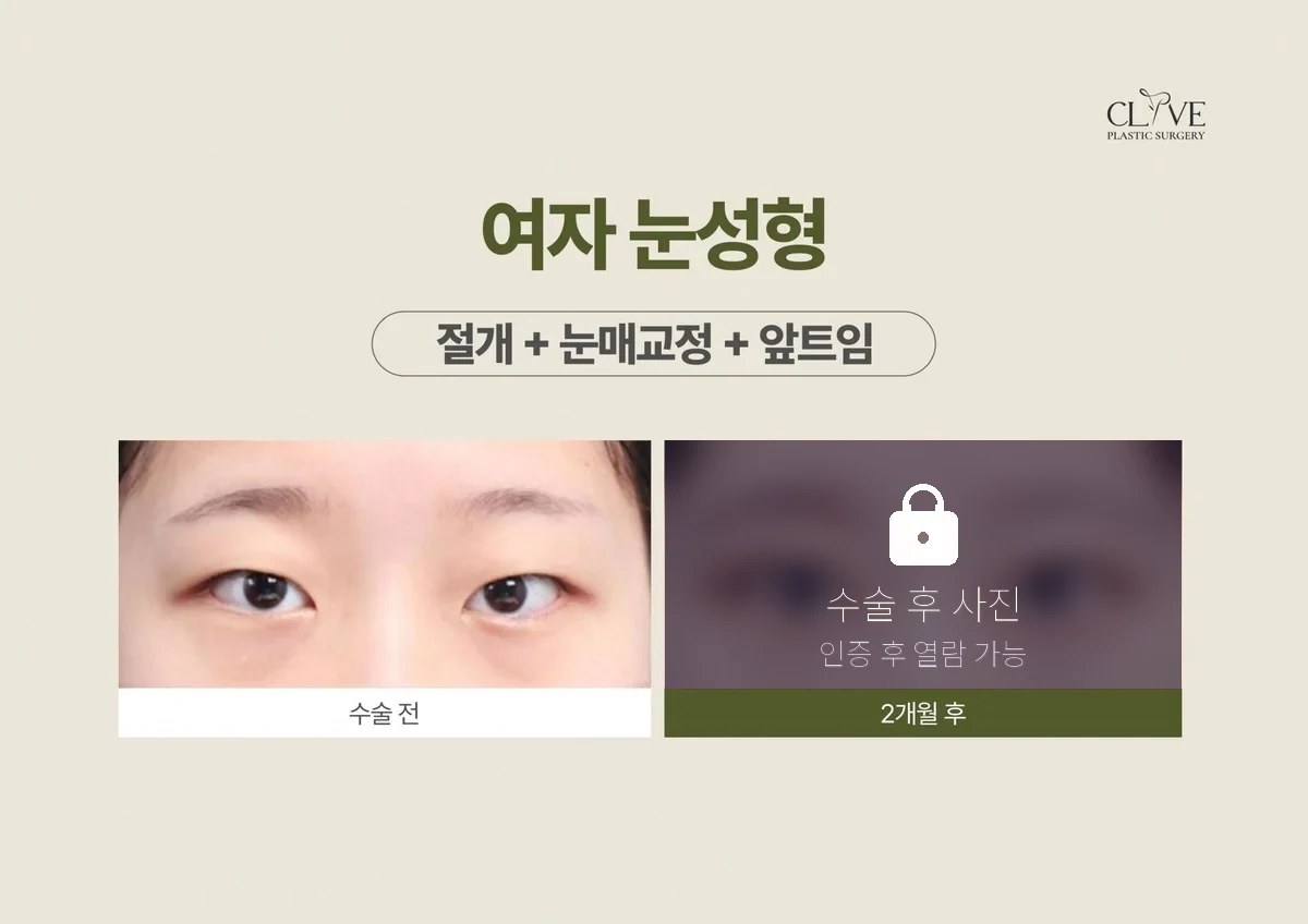 눈성형 절개+눈매교정+앞트임 전후
