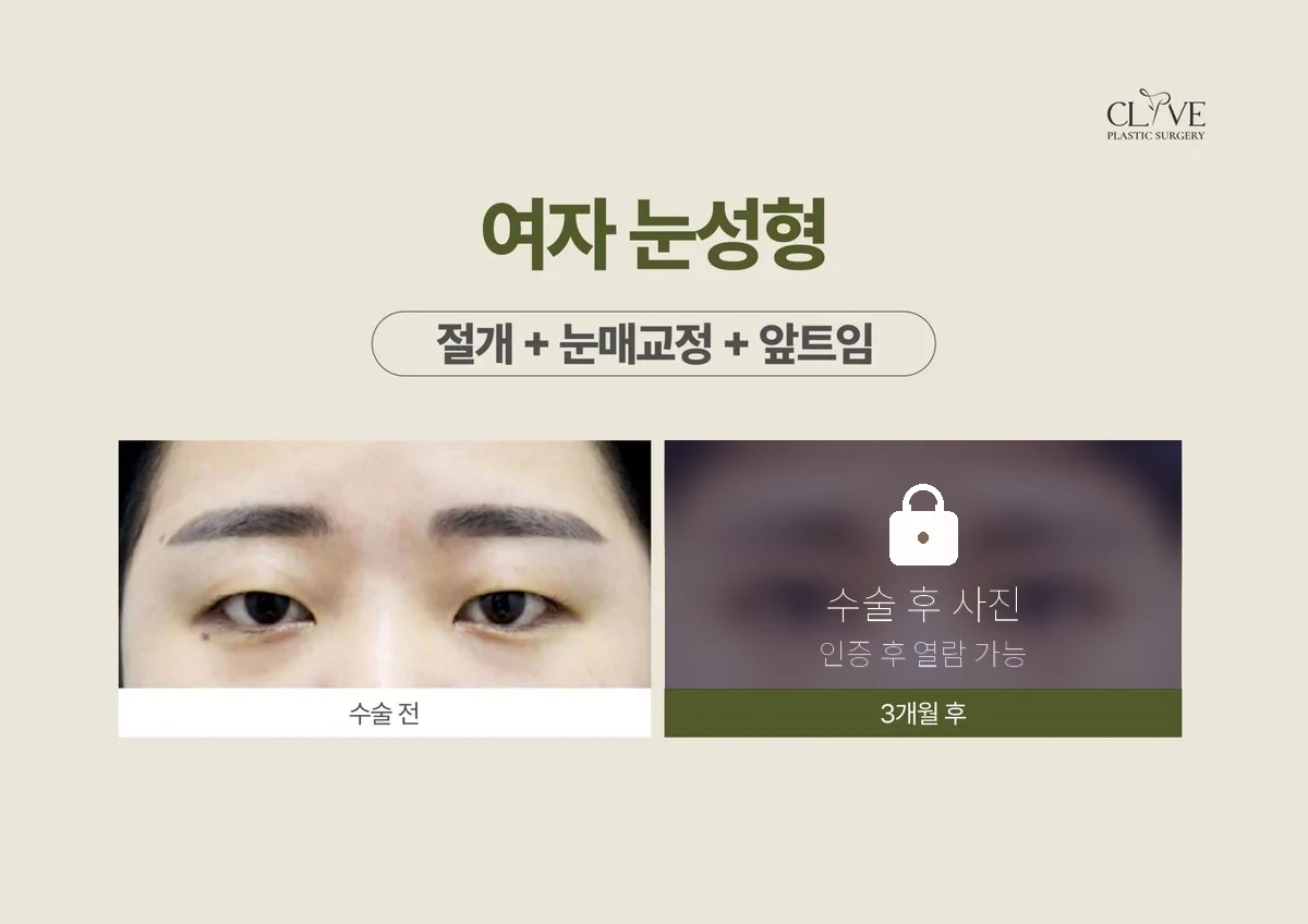 눈성형 절개+눈매교정+앞트임 전후