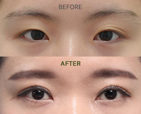 Kelopak Mata Ganda Natural Adhesion Sebelum, Sesudah Operasi