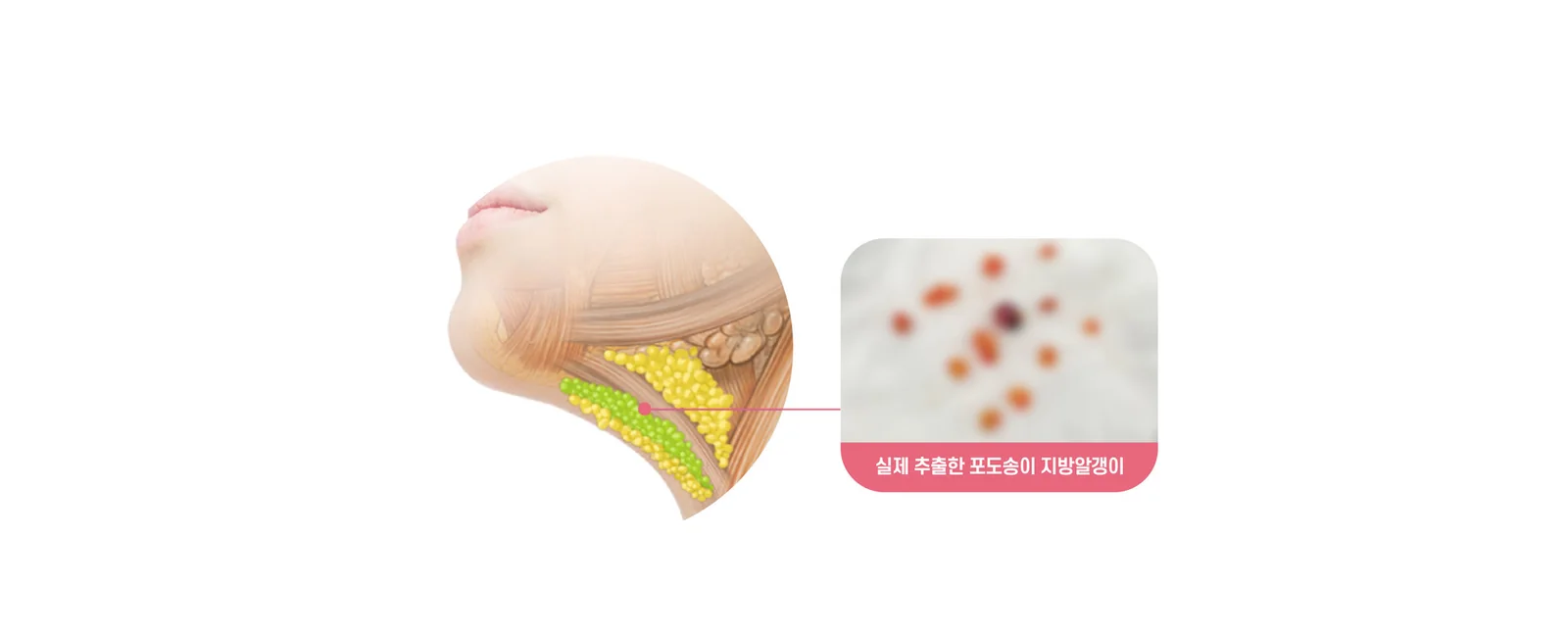 근육층에 붙은 지방알갱이 제거 — 실제 추출한 포도송이 지방알갱이
