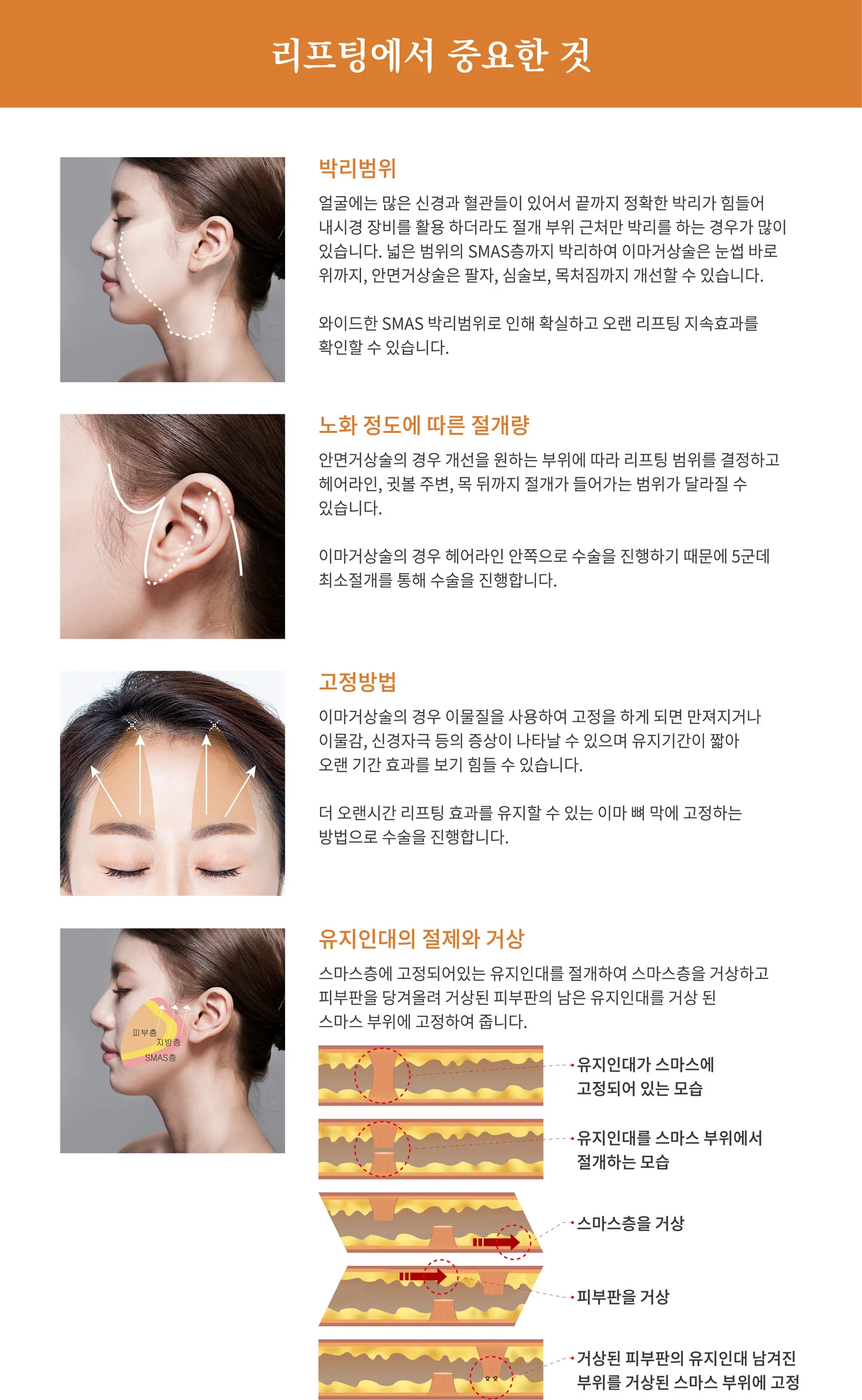 리프팅에서 중요한 것 — 박리범위·절개량·고정방법·유지인대의 절제와 거상