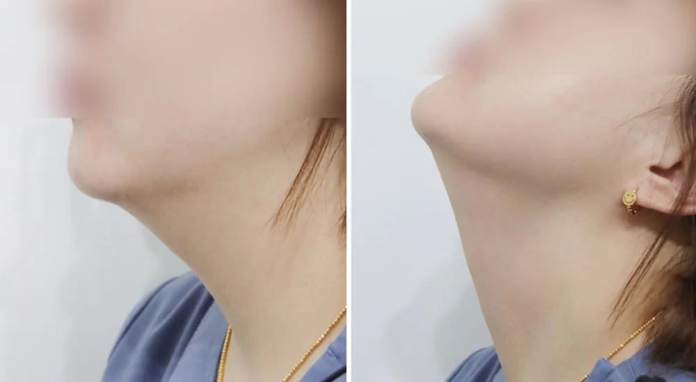 턱과 목의 경계가 불분명한 이중턱