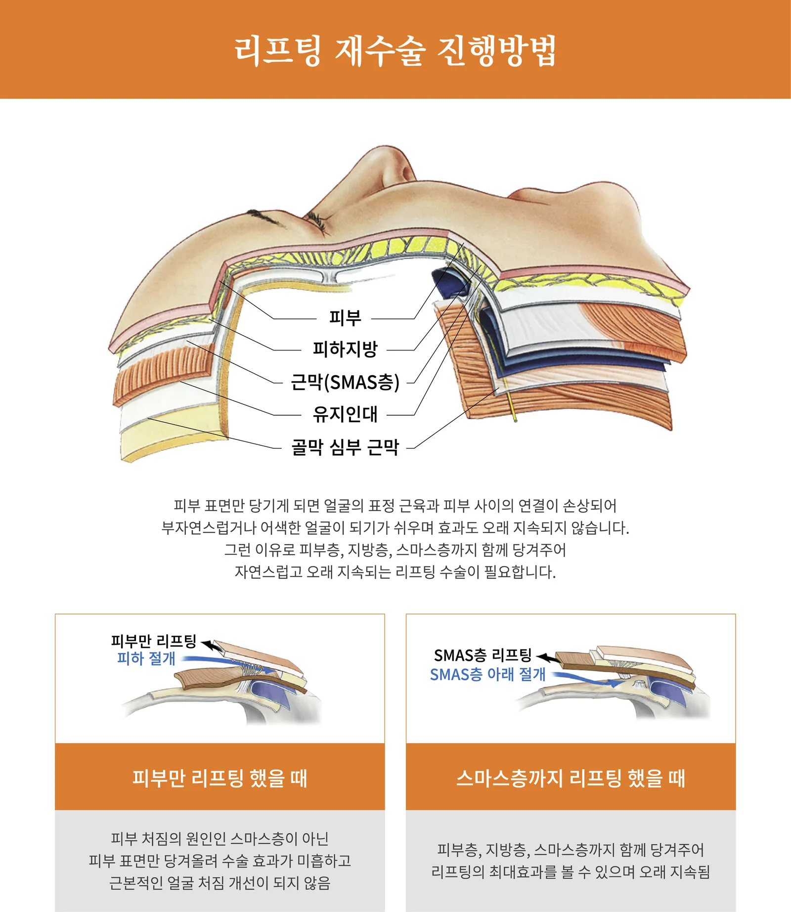 리프팅 재수술 진행방법 — 피부만 리프팅과 스마스층까지 리프팅 비교