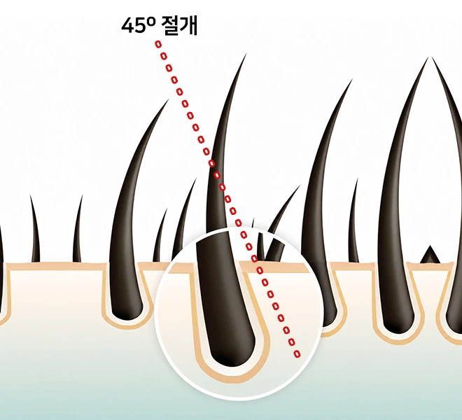모근을 살리는 45도 절개 도해
