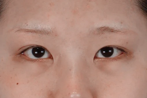 눈밑지방재배치 수술 전