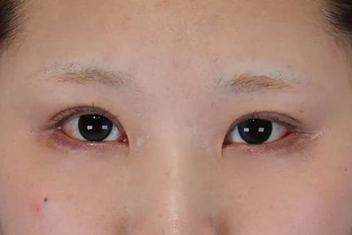 눈밑지방재배치 수술 후 1개월