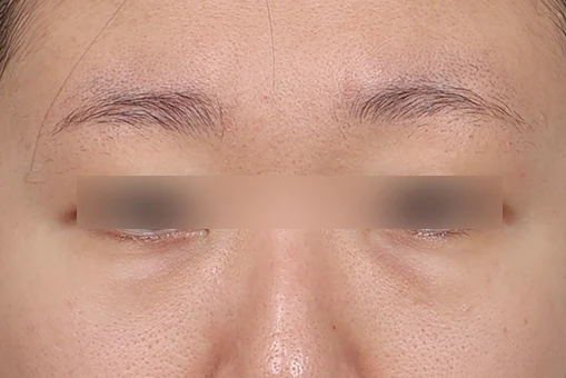 눈밑지방재배치 수술 전