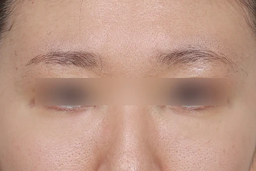 눈밑지방재배치 수술 후 1개월