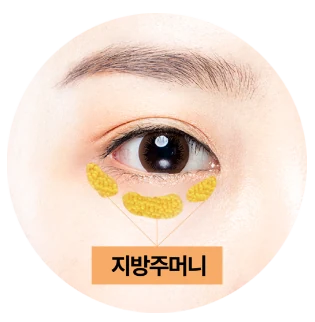 안구 밑 3개의 지방주머니
