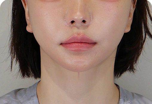 하안부 세미거상 수술 후 1개월
