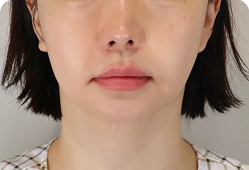 하안부 세미거상 수술 전