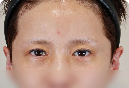 상안부 세미거상 수술 후 1개월