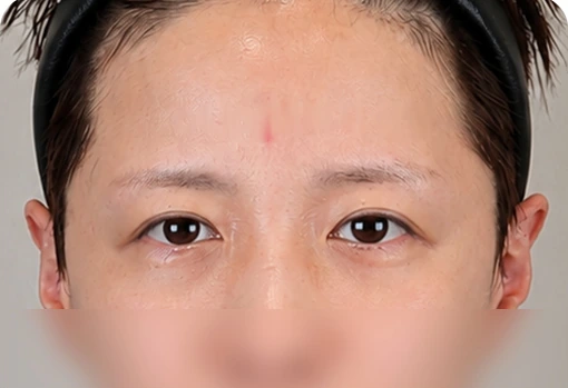 상안부 세미거상 수술 전