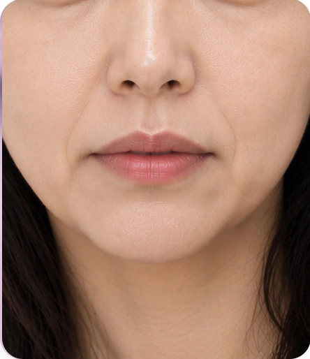 하안부 처짐 개선 — 턱라인 처짐, 마리오네트