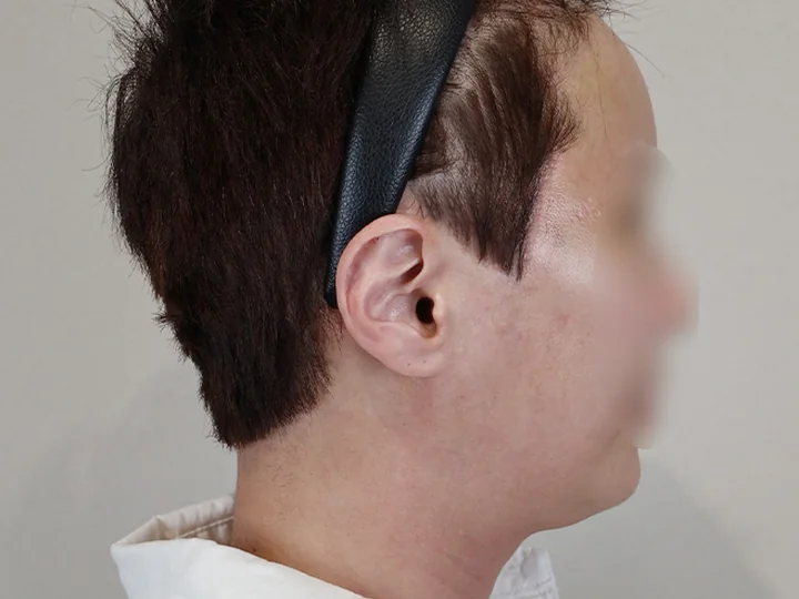세미거상 상안부 수술 후 1개월 절개 부위